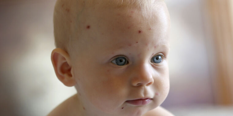 more-than-half-of-chickenpox-diagnoses-are-wrong,-study-finds