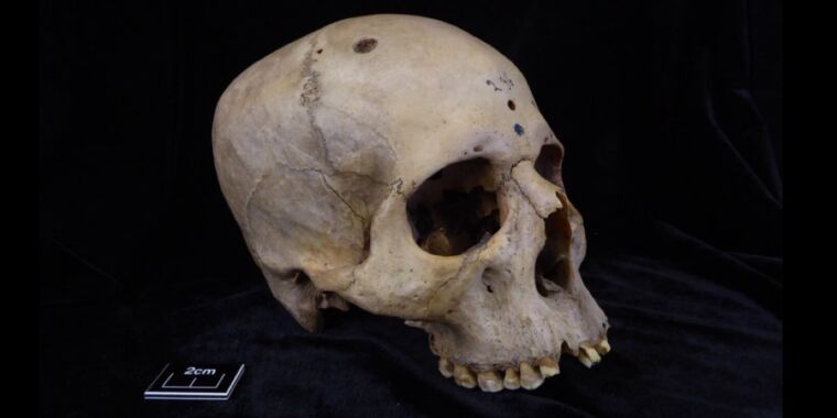 ancient-egyptian-skull-shows-evidence-of-cancer,-surgical-treatment