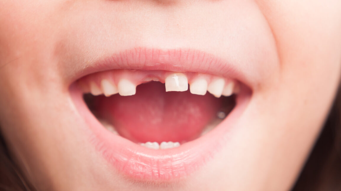 rfk-jr’s-plan-to-ban-fluoride-supplements-will-“hurt-rural-america,”-dentists-say