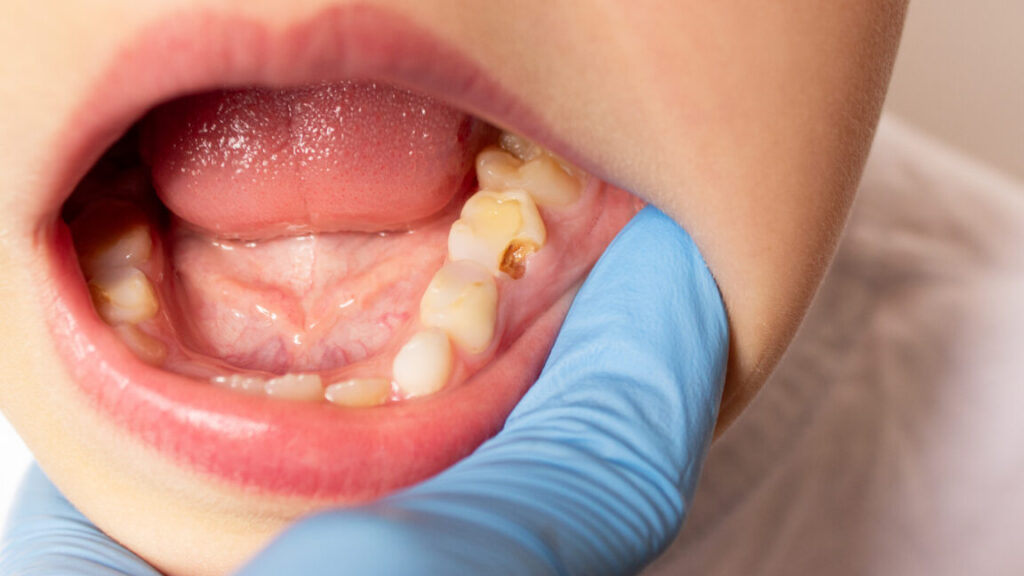 rfk-jr’s-fluoride-ban-would-ruin-25-million-kids’-teeth,-cost-$9.8-billion