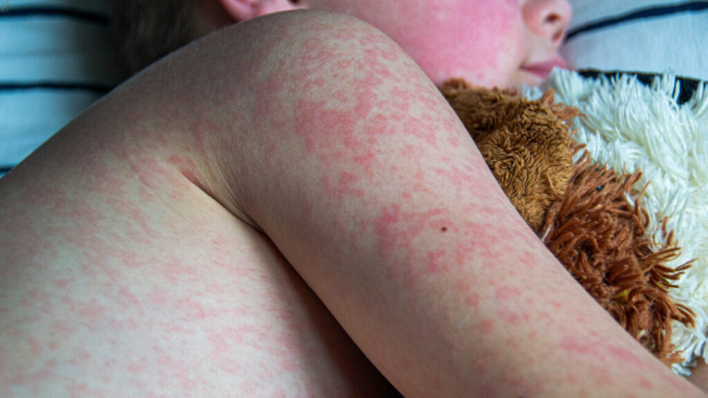 measles-cases-reach-33-year-high-as-rfk-jr.-pursues-anti-vaccine-agenda