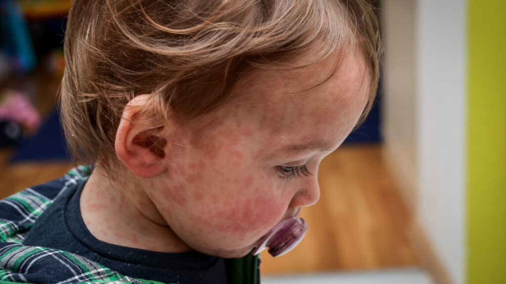child-dies-of-horrifying-measles-complication-in-los-angeles