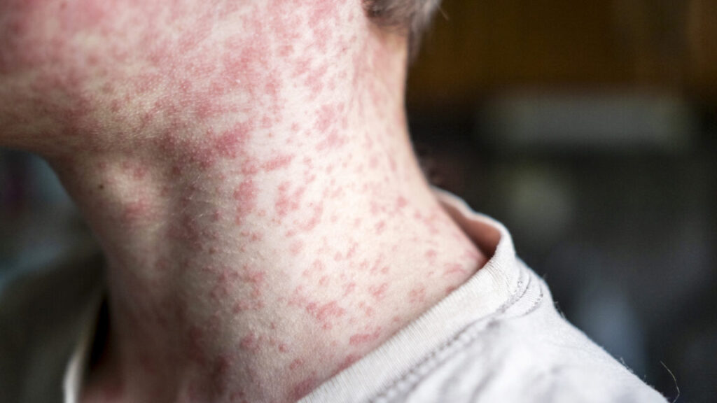 measles-outbreak-investigation-in-utah-blocked-by-patient-who-refuses-to-talk