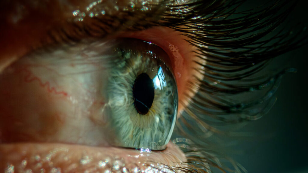 bad-sleep-made-woman’s-eyelids-so-floppy-they-flipped-inside-out,-got-stuck